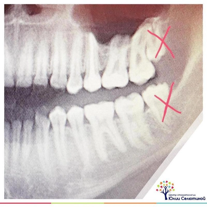 Удаление зуба: что делать дальше?