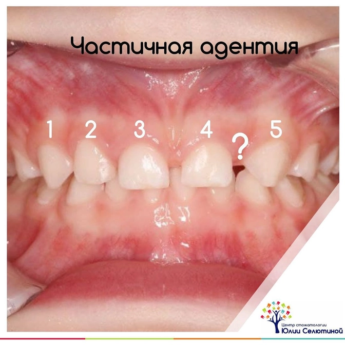 Виды аномалий зубов 