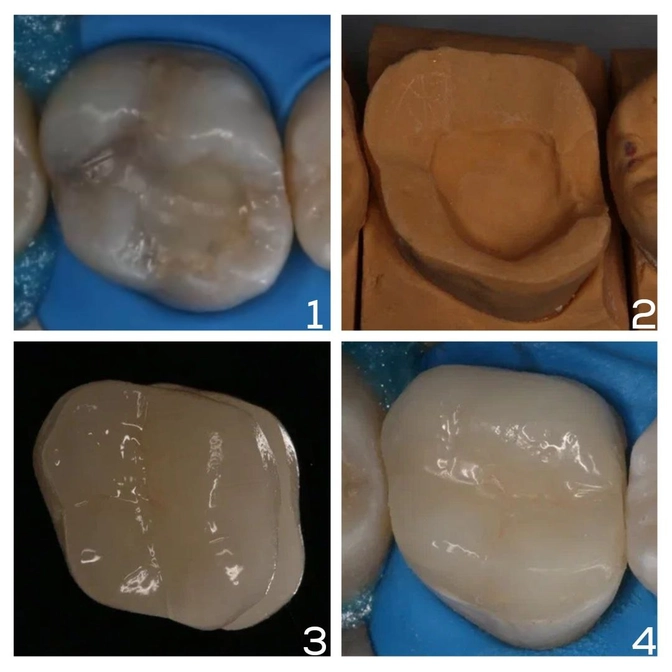 Восстановление "живого" зуба вкладкой 