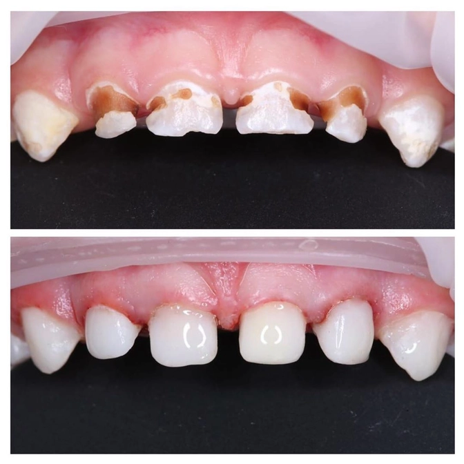 Лечение молочных зубов в условиях наркоза