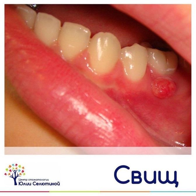 Свищ молочного зуба.