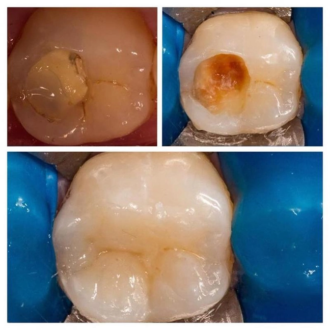 Вторичный кариес. 