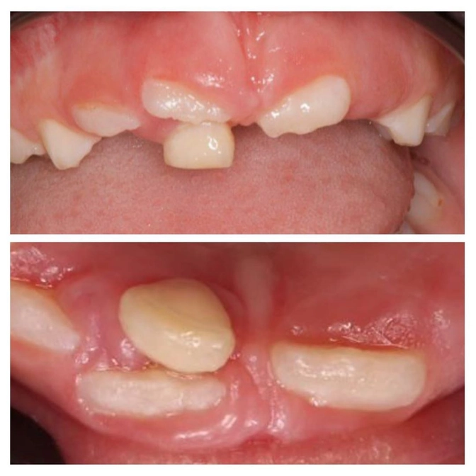 Когда молочный зуб прорезался, а постоянный еще не выпал...