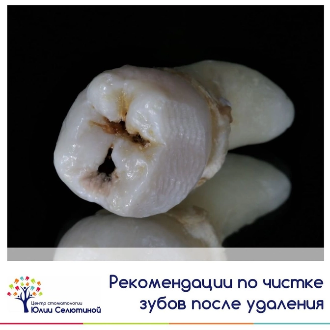 Рекомендации по чистке зубов  после удаления