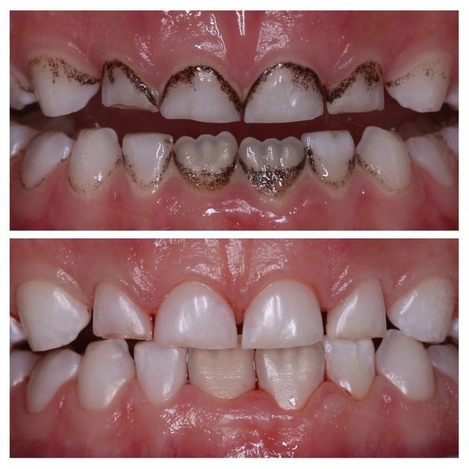 Самый популярный и часто задаваемый вопрос — откуда берется налет Пристли и что с ним делать?