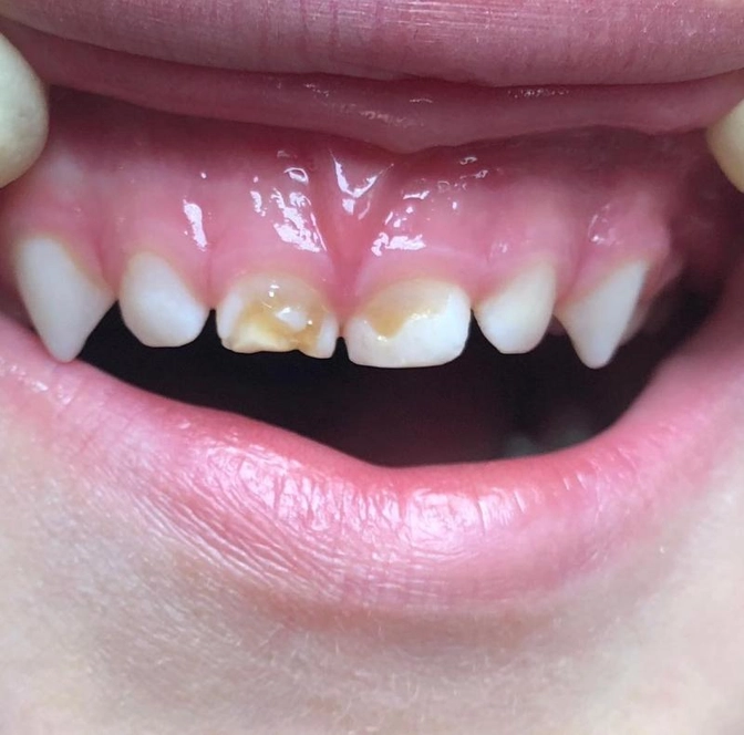 Клинический случай: стабилизация кариеса