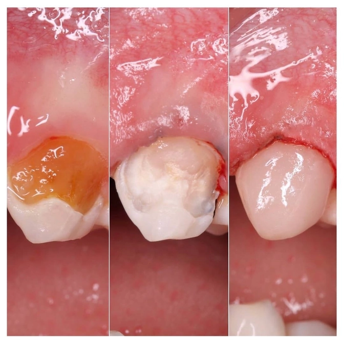 Лечение кариеса в прилесневой области 