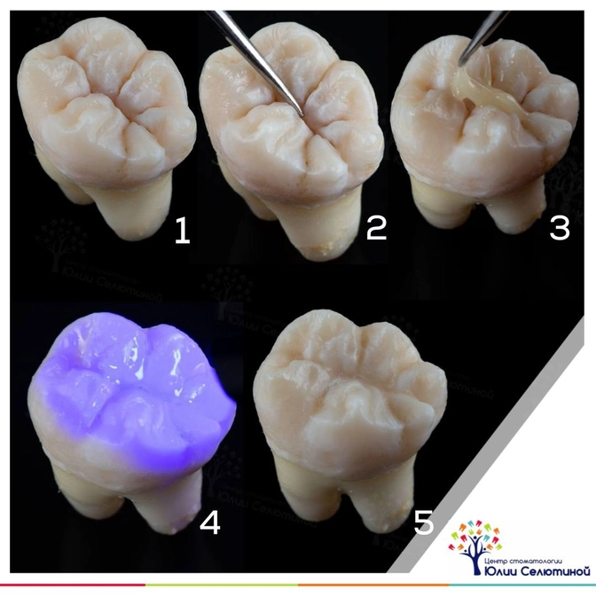 Герметизация фиссур - профилактика кариеса 