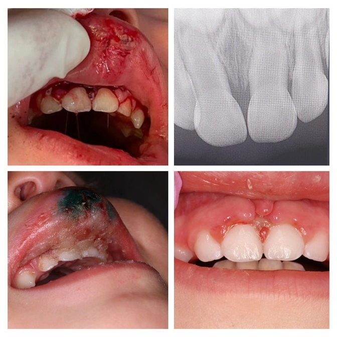 Действия при травме слизистых оболочек. 