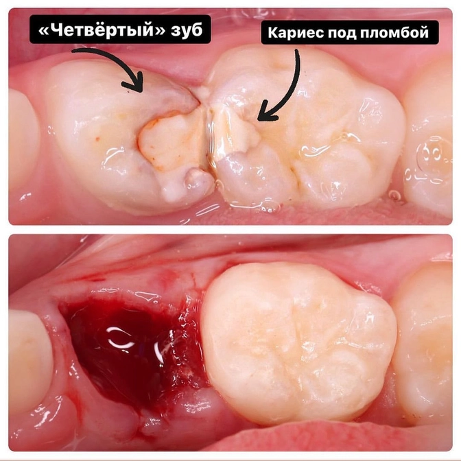 Перелечивание молочных зубов. 