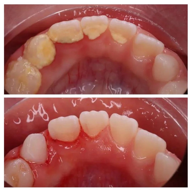 Зубной камень у детей 