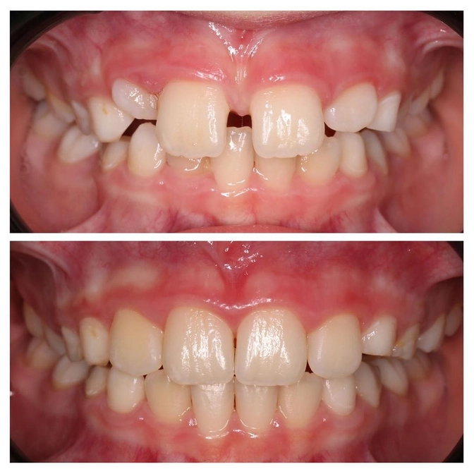 Исправление прикуса с помощью пластинок. 