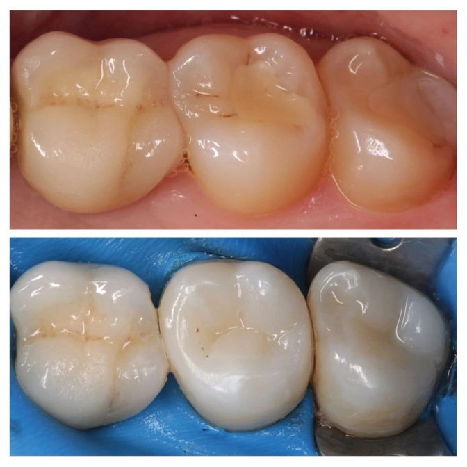 Почему за леченными зубами нужно следить? 