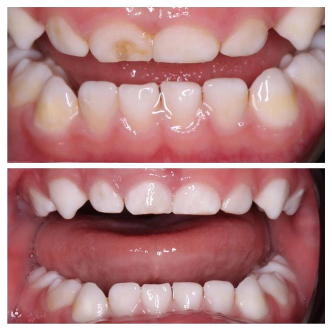 Гипоплазия молочного резца