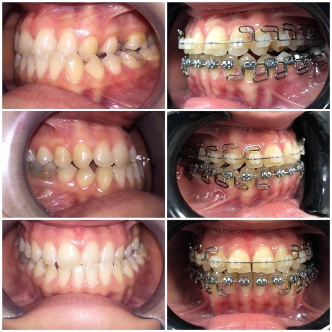 Неправильный прикус: последствия.
