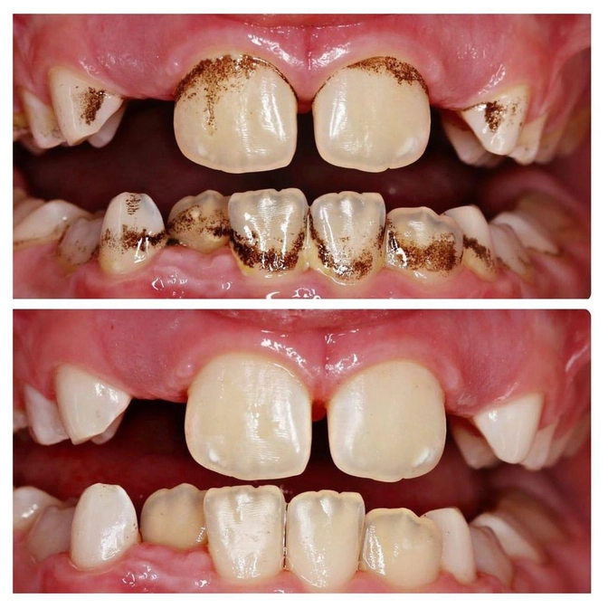 Налет Пристли бывает только у маленьких детей?