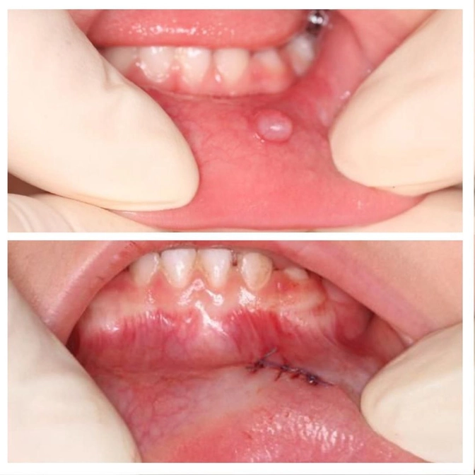 Ретенционная киста: как она выглядит и что делать? 