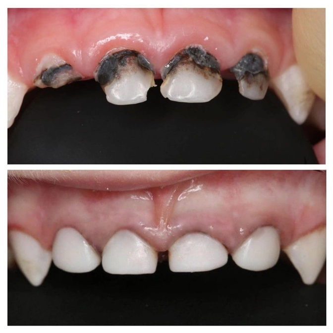 Лечение зубов ребёнка в условиях наркоза 