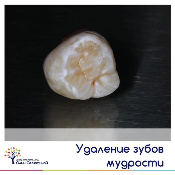 Удаление зуба мудрости.