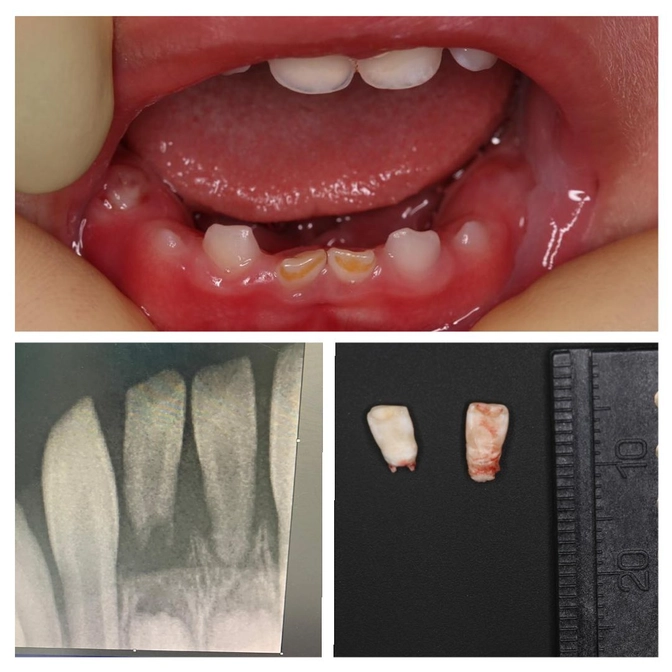 Натальные зубы: что делать, если малыш родился с зубами?