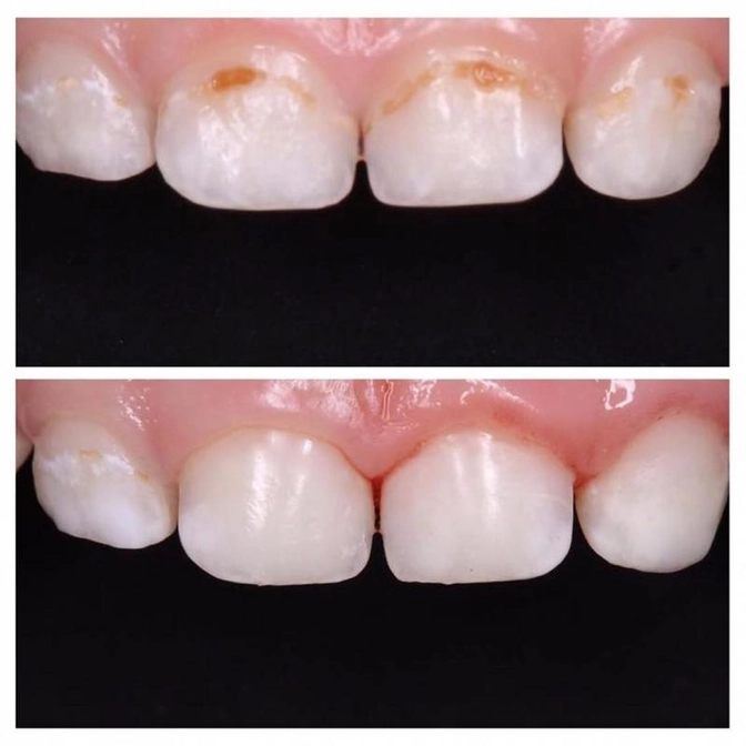 Клинический случай: лечение кариеса центральной группы молочных зубов