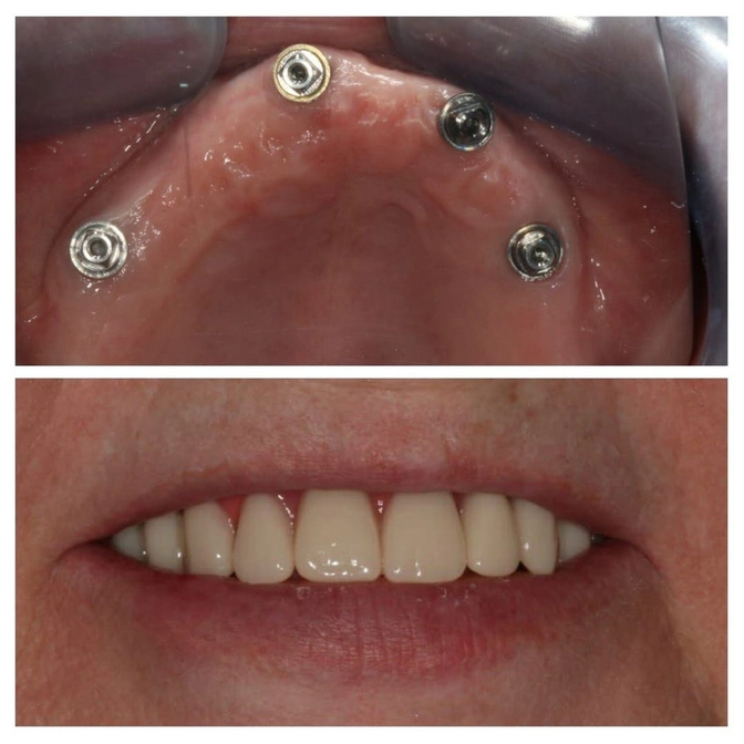 Полный протез на 4-х имплантах 