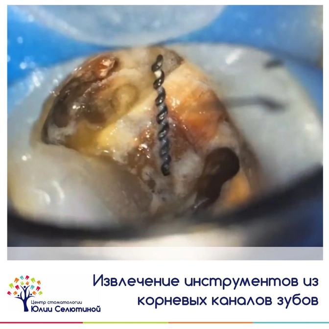 Извлечение инструментов из корневых каналов зубов