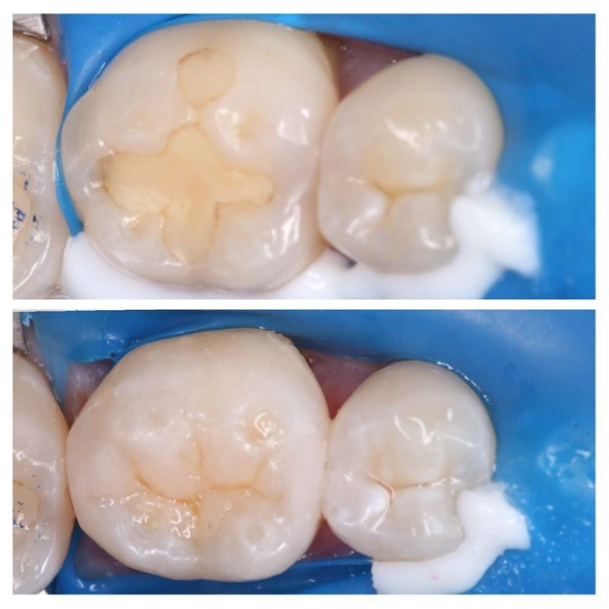 Замена старых пломб на новые: зачем это нужно?