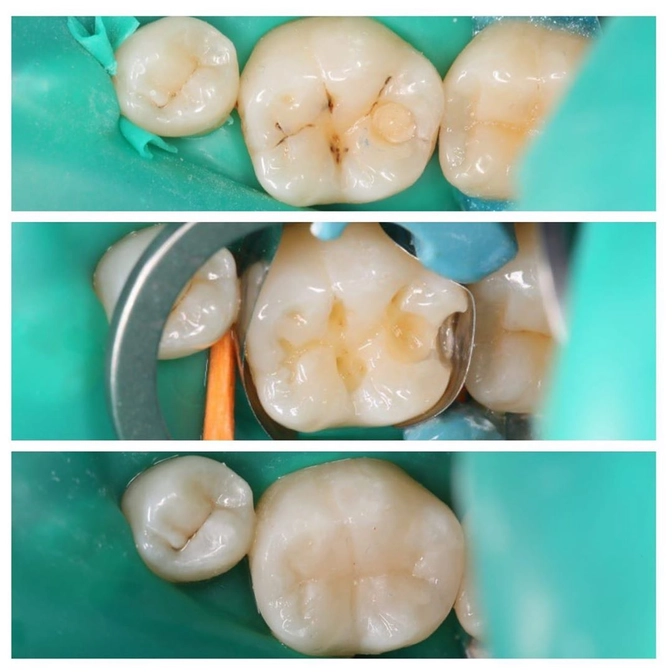 Лечение кариеса