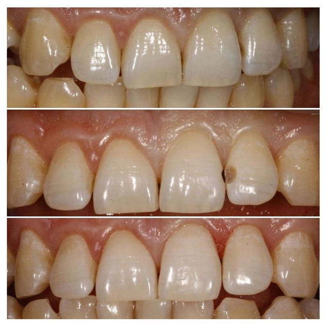 Симптомы "контактного" кариеса 