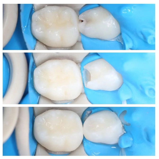 Лечение кариесс на контактной поверхности