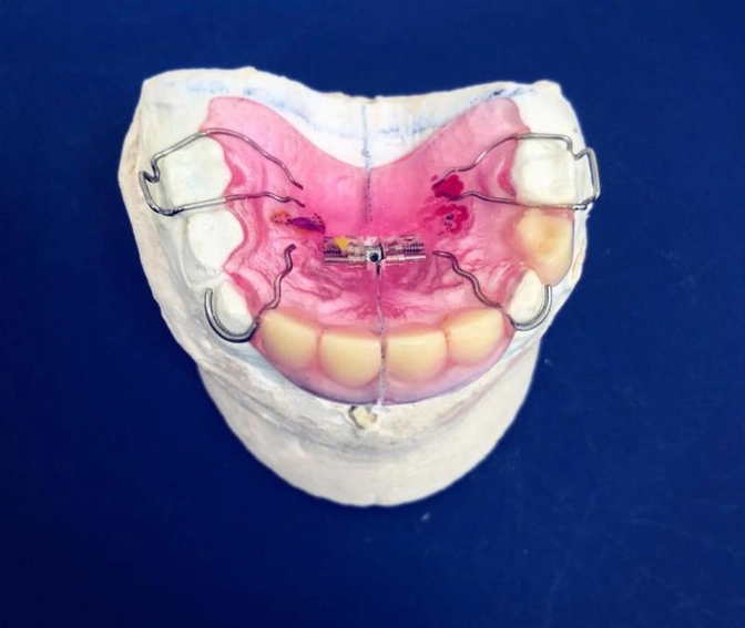 Заместительная пластинка.