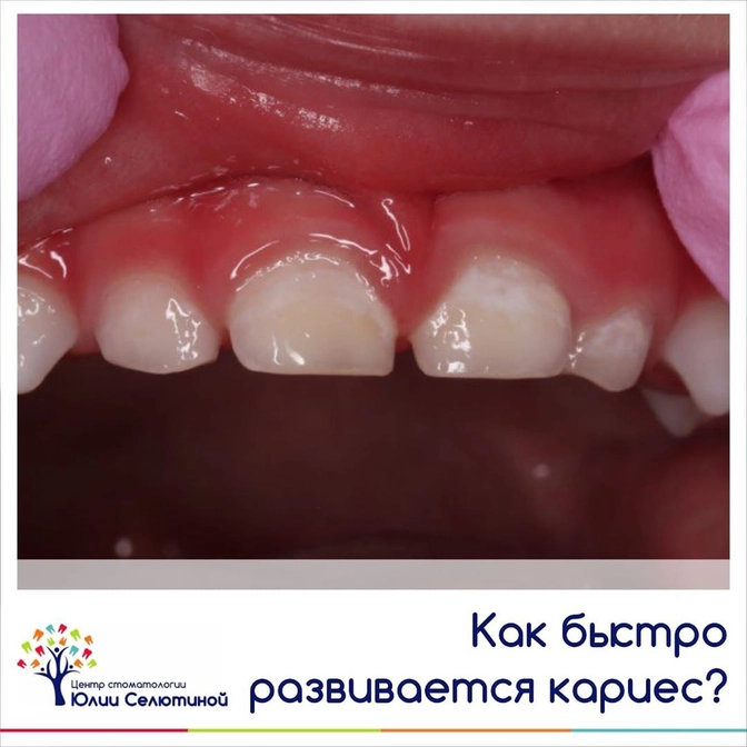 Как быстро развивается кариес?