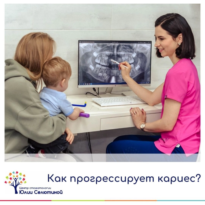 Как прогрессирует кариес? 