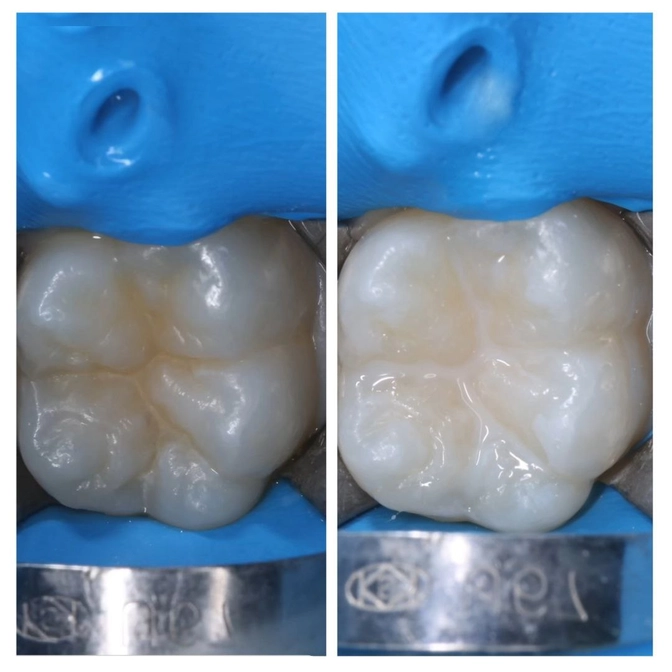Все про герметизацию фиссур