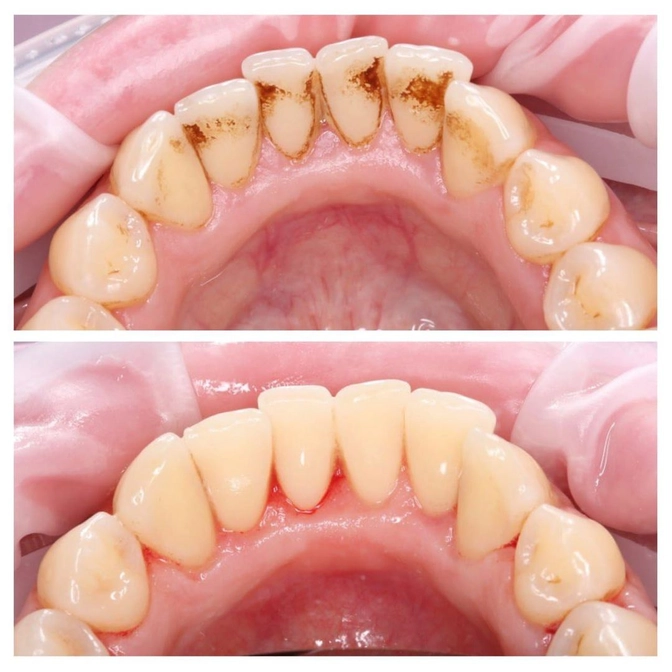 Профессиональная гигиена полости рта у курильщика