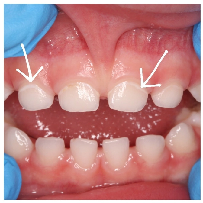 Лечение зубов малышей и психологическая травма...