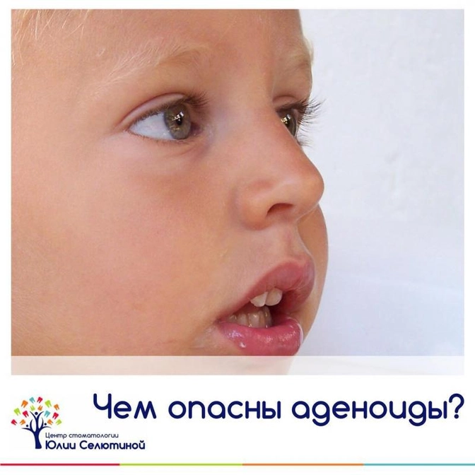 Аденоиды и их последствия.