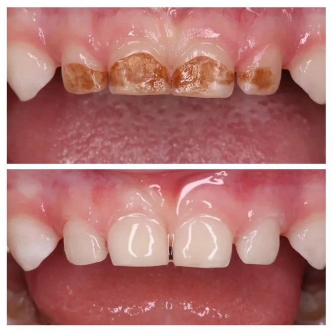 Лечение кариеса у трехлетки без наркоза 