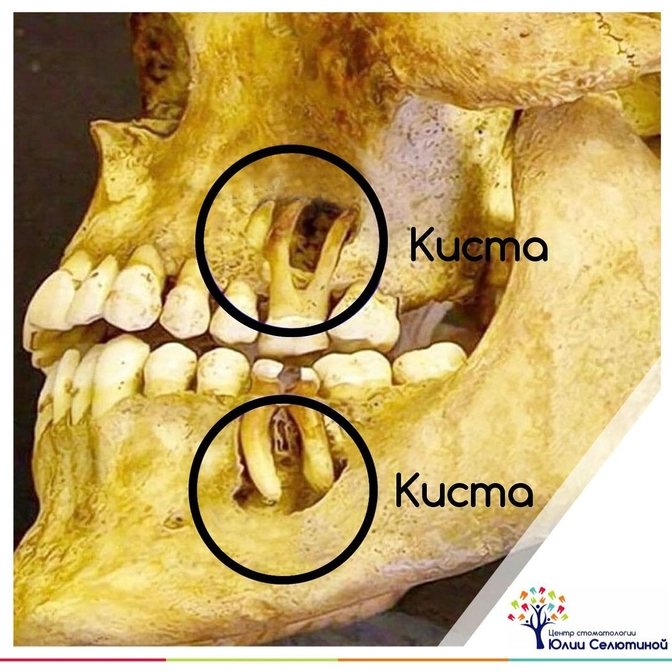 "Киста" зуба 
