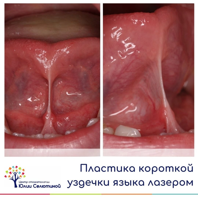 Пластика уздечки языка лазером 