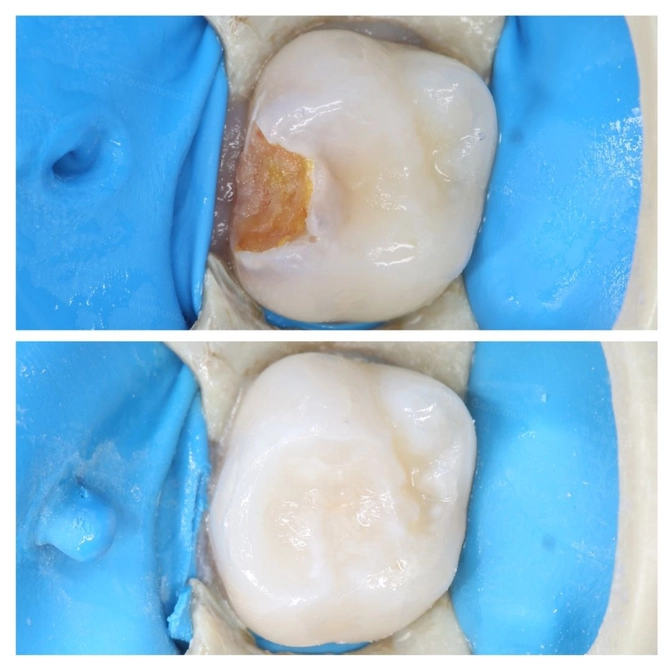 Контактный кариес молочного зуба