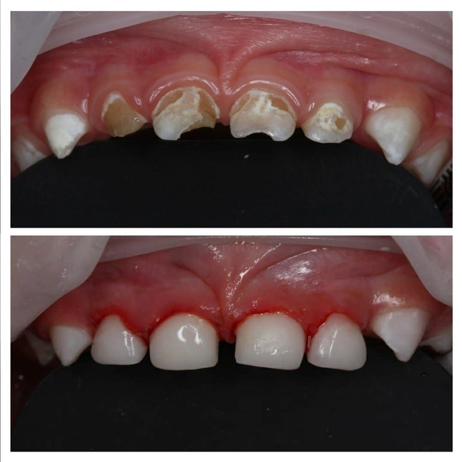 Агрессивность кариеса раннего детского возраста.