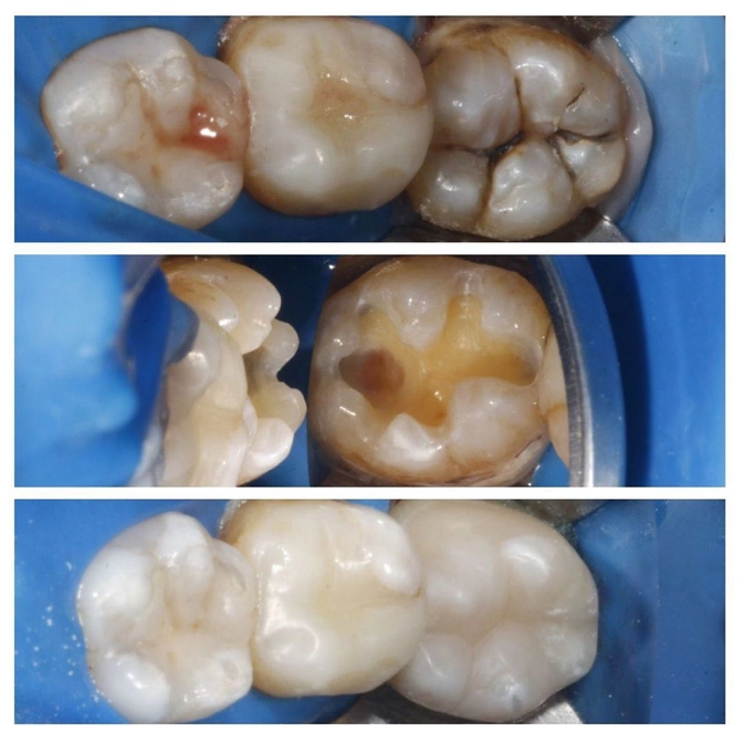 Лечение кариеса постоянного моляра 