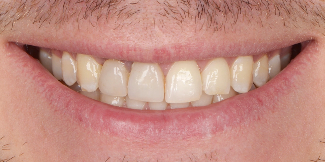 Изображение зубов после выполненой работы