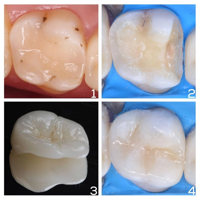 Замена большой пломбы на вкладку