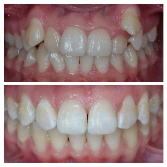 Сколько времени занимает брекет-лечение? 