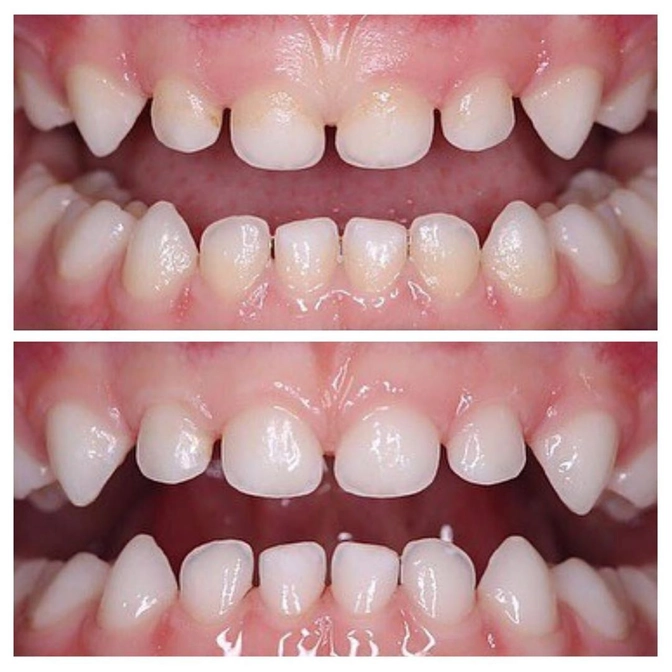 Зачем делать профессиональную чистку зубов?