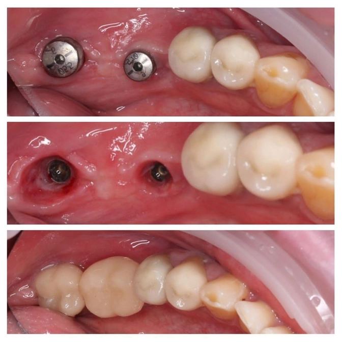 Хирургические этапы перед протезированием 
