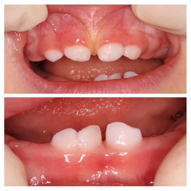 Сросшиеся зубы - синоадентия 